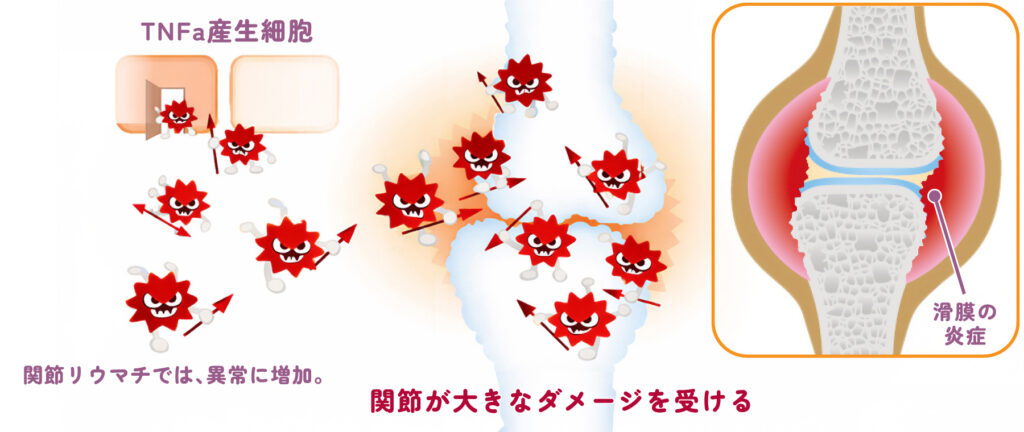 関節リウマチでは、骨を攻撃