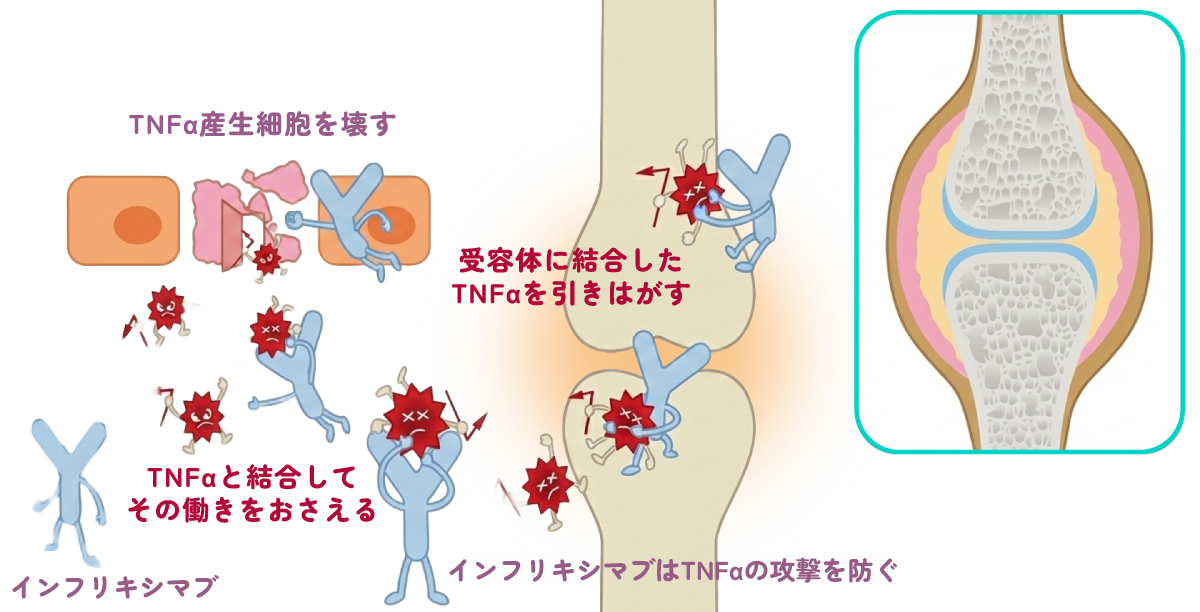 炎症を悪化させるTNFαのはたらきを抑える、インフリキシマブ